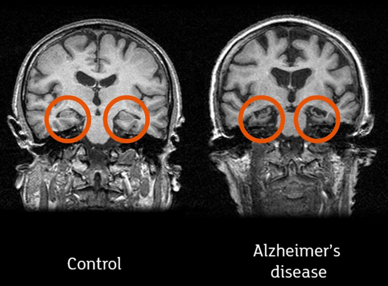 Магнітно-резонансна томографія (МРТ) мозку здорової людини (зліва) та пацієнта із хворобою Альцгеймера (справа). Гіпокамп обведено жовтогарячими колами. Prof. John O’Brien / University of Cambridge and Newcastle University
