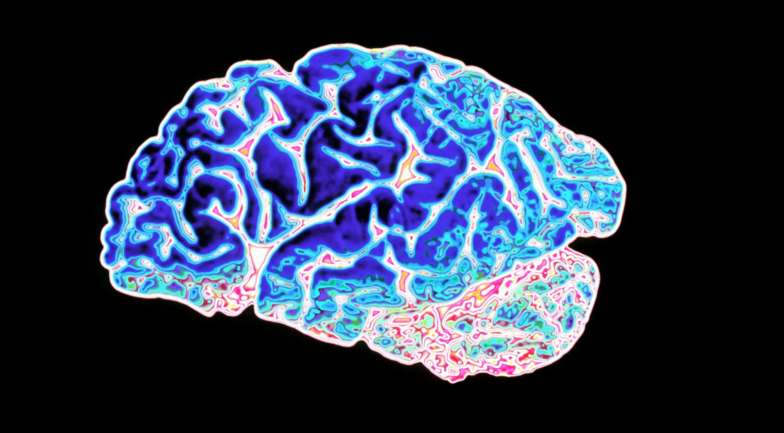 Оброблене зображення мозку пацієнта з хворобою Альцгеймера. Alfred Pasieka / Getty Images