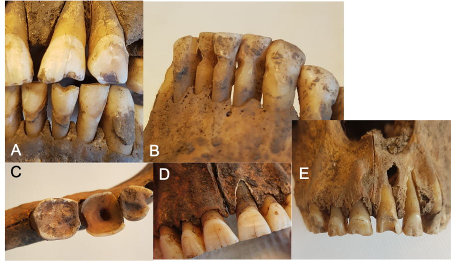 Поширеність карієсу та інші стоматологічні патології зубів досліджуваних вікінгів. Carolina Bertilsson et al. / PLOS One, 2023