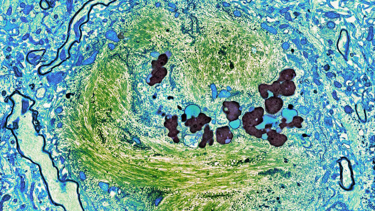 Нейрофібрилярний клубок із токсичного тау всередині нейрона.&amp;nbsp;Thomas J. Deerinck / Corbis