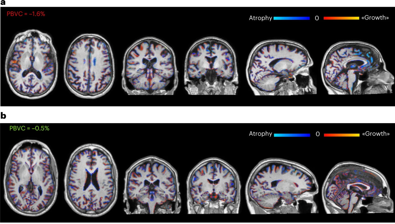 Ступінь атрофії мозку (синій) у людини з групи низької дози стовбурових клітин (зверху) та високої (знизу).&amp;nbsp;Angela Genchi et al. /&amp;nbsp;Nature Medicine, 2023