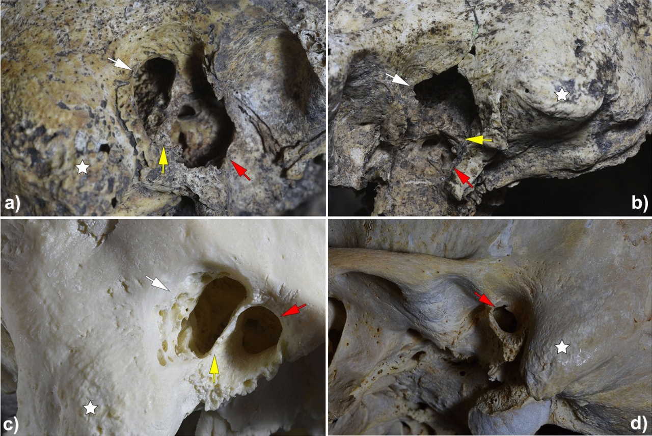 Верхні зображення - права та ліва скроневі кістки дослідженого черепа. Нижні - мастоїдектомія, проведена на сучасному черепі студентами.&amp;nbsp;Sonia Diaz-Navarro et al. / Scientific Reports, 2022