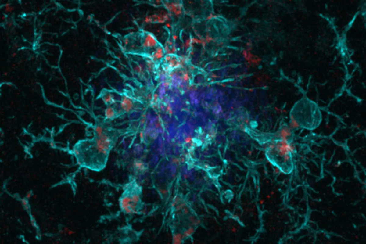 Клітини мікроглії (бірюзові з червоними цятками) оточують амілоїдну бляшку (синя).  Brian Lananna / Washington University School of Medicine in St. Louis