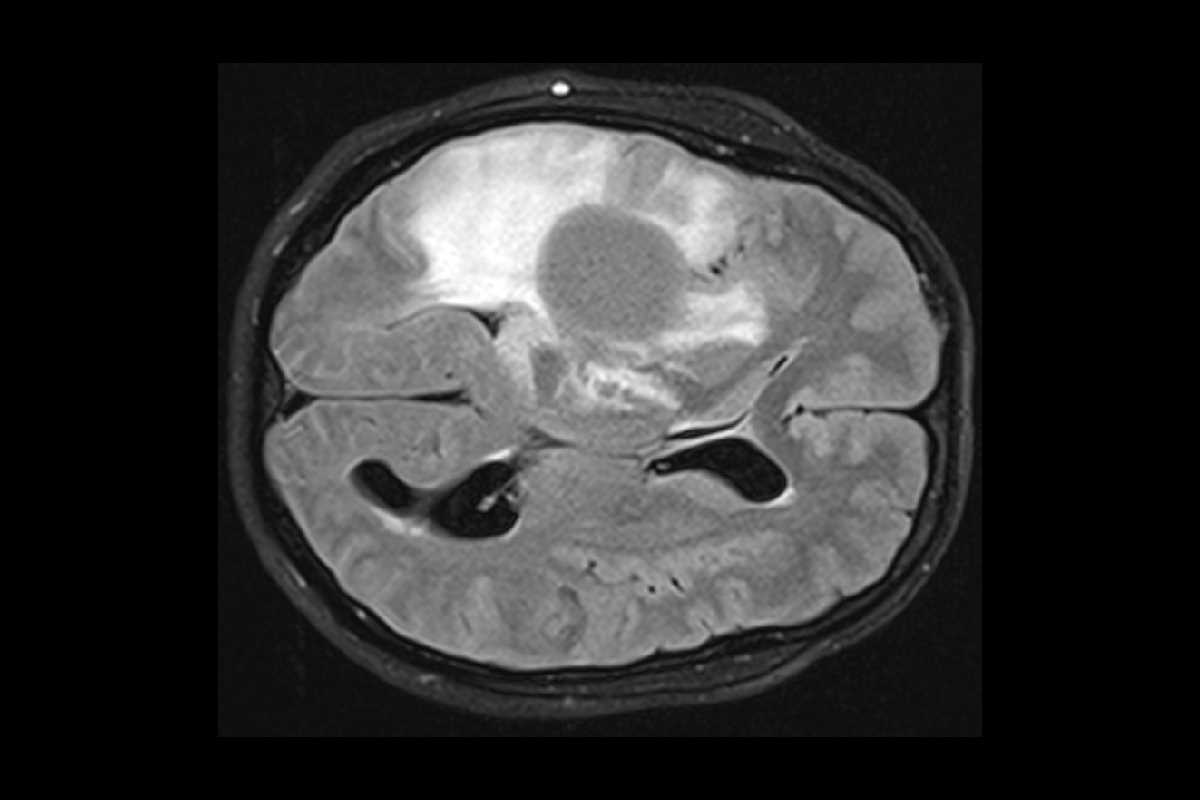 МРТ-зображення мозку з дифузною гліомою. Universitätsmedizin Mannheim