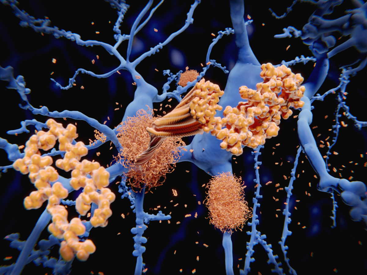 Бета-амілоїдні бляшки на нейронах. Juan Gaertner / Shutterstock