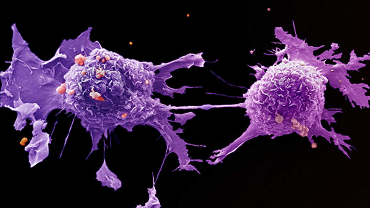 Клітини раку легень під мікроскопом. LRI EM Unit