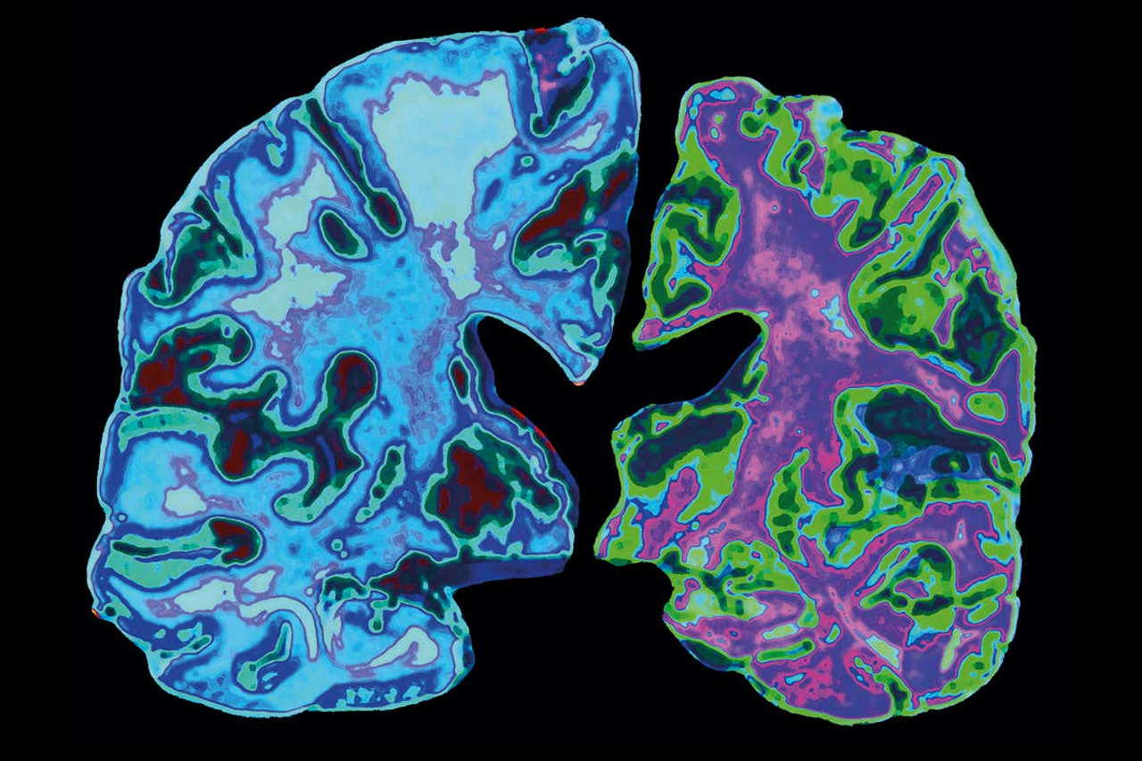 Зліва — півкуля мозку здорової людини, справа — атрофована півкуля людини з хворобою Альцгеймера. Jessica Wilson / Science Photo Library