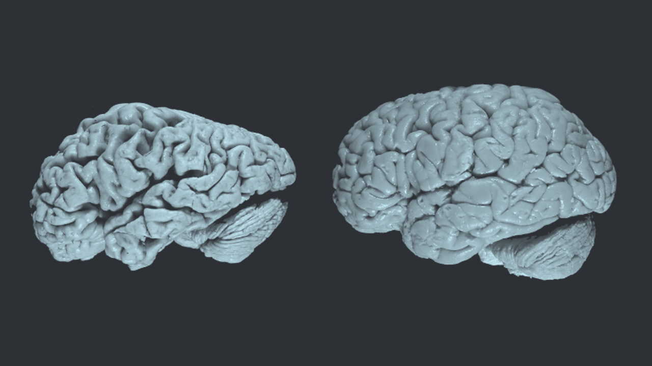 Мозок людини з хворобою Альцгеймера (зліва) та без (справа). UC San Francisco