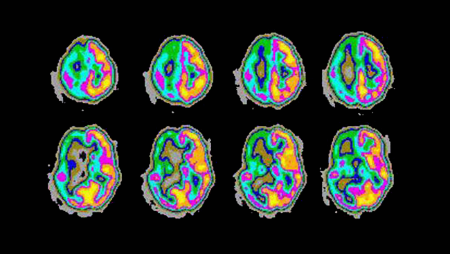 Аномально висока активність правої частини головного мозку під час нападу епілепсії. RME Sabbatini