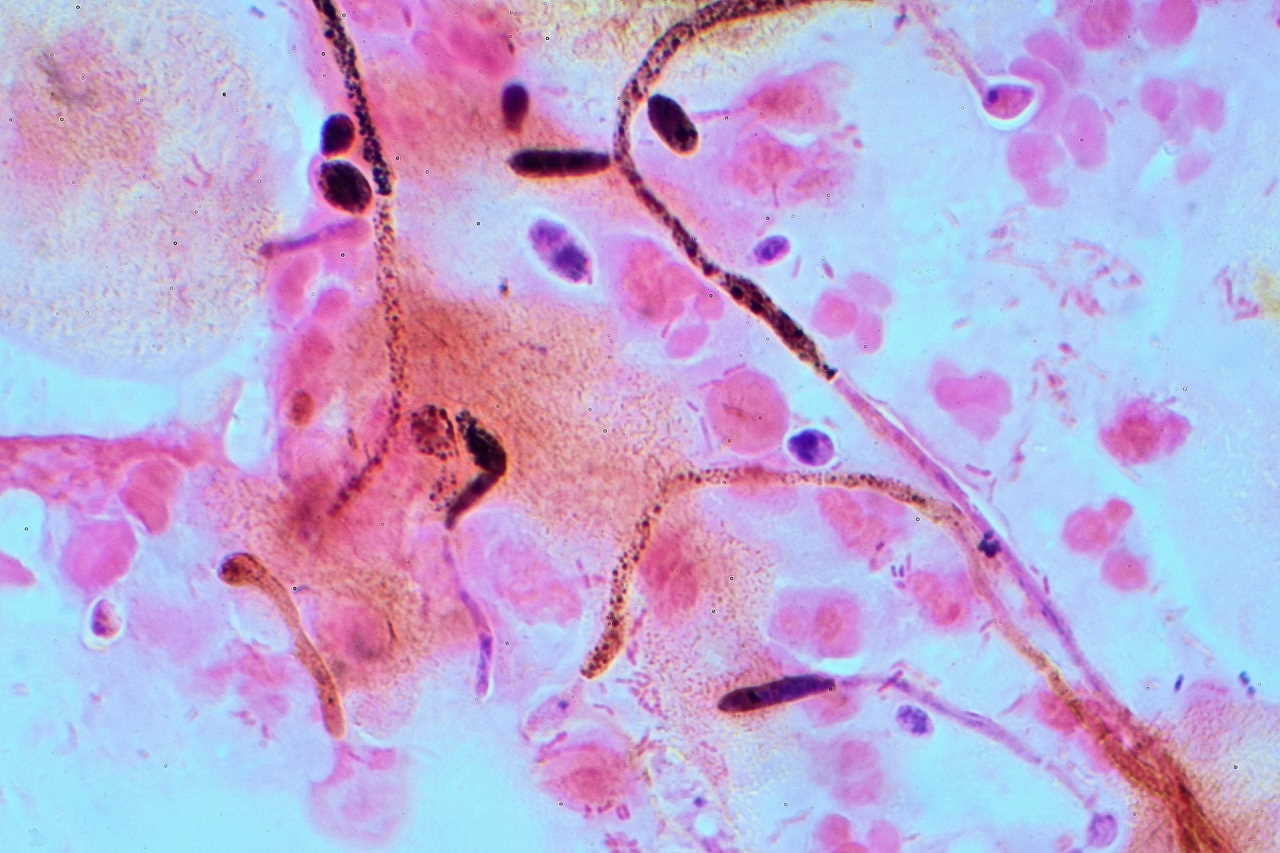 Candida albicans з вагінального мазка. Graham Beards / Wikimedia Commons