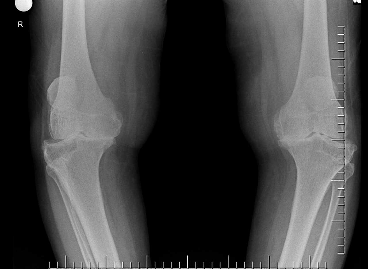 Рентген пацієнта з остеоартритом колінних суглобів. Radiopaedia