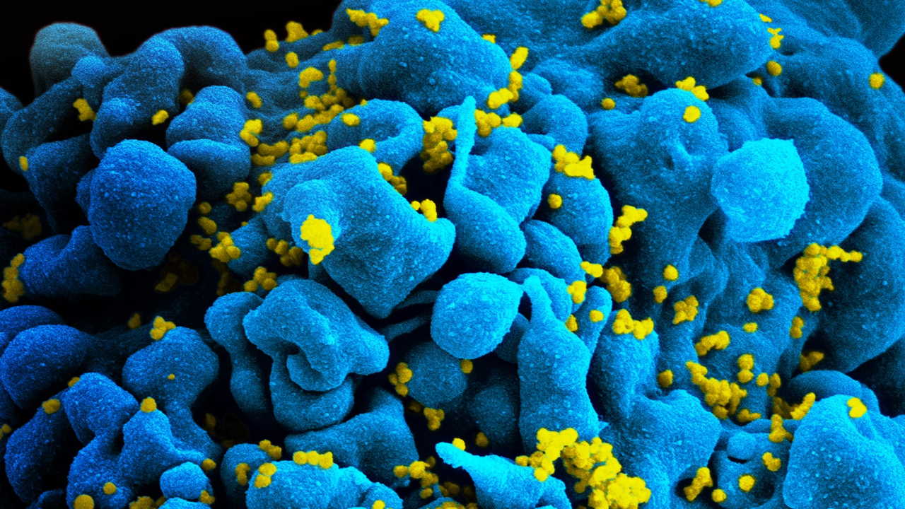 T-лімфоцити, інфіковані вірусом імунодефіциту людини (жовто-зелений), під сканувальним електронним мікроскопом / Wikimedia Commons