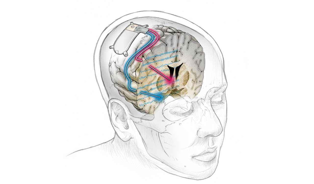 Схематичне зображення стимулювального імплантату в мозку пацієнтки. Ken Probst / UCSF
