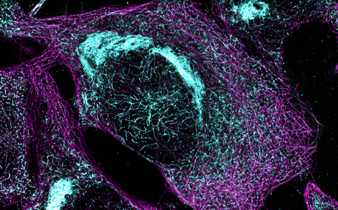 Клітини з агрегатами тау-білка, характерними для хвороби Альцгеймера.&amp;nbsp;Melina Gyparaki, Melike Lakadamyali’s lab, Perelman School of Medicine at the University of Pennsylvania