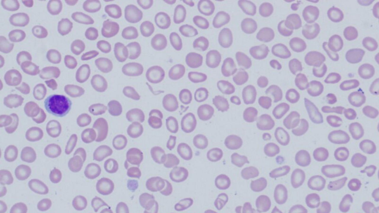 Мазок крові пацієнта із бета-таласемією, на якому помітні деформовані еритроцити.&amp;nbsp;David T Lynch, MD