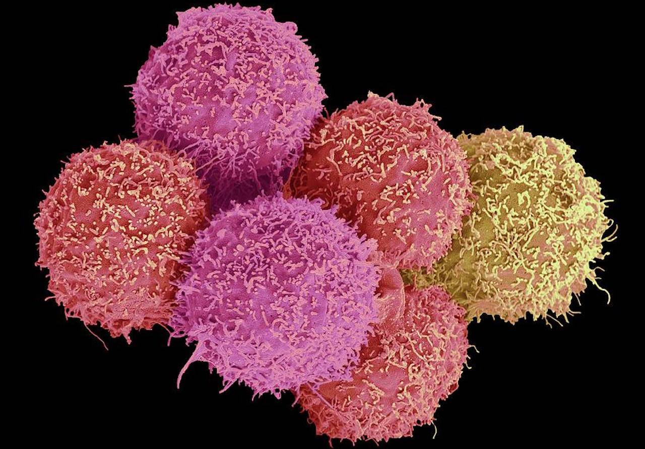 Клітини раку сечового міхура.&amp;nbsp;Steve Gschmeissner / Science Photo Library / Pixels