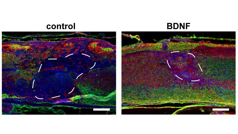 Спинний мозок мишей через вісім тижнів після лікування. Зліва тваринам ввели лише каркасний матеріал. Справа зображено спинний мозок, лікований біоматеріалом з векторами генної терапії, тут можна бачити більше аксонів (червоні).&amp;nbsp;Seidlits et al. /&amp;nbsp;APL Bioengineering, 2021