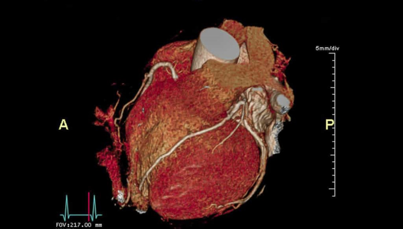 КТ-скан серця. NSW Cardiology