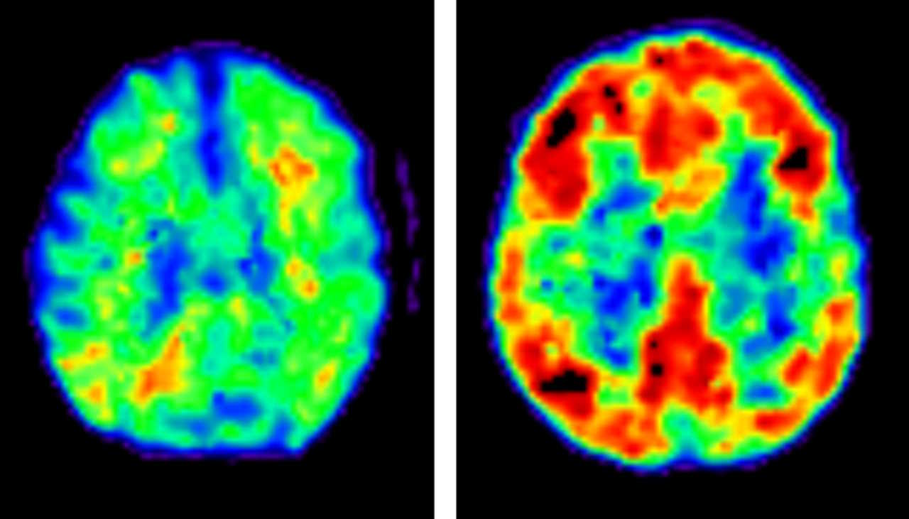 Мозок здорової людини (зліва) та мозок пацієнта з хворобою Альцгеймера (справа). Червоним та іншими гарячими кольорами показані бета-амілоїдні включення. Dr. Manja Lehmann / University College London &amp;amp; University of California SF