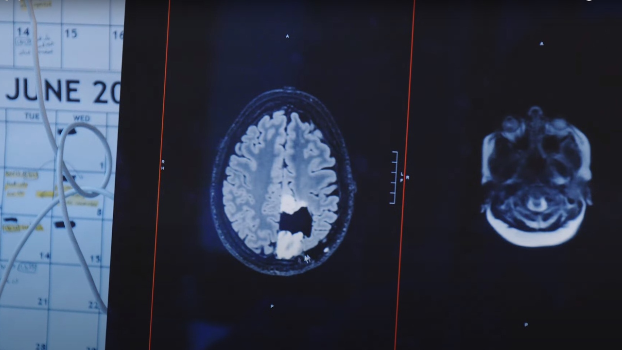 Зображення з томографії мозку пацієнта із видаленою пухлиною.&amp;nbsp;UCSFMedicalCenter / Youtube