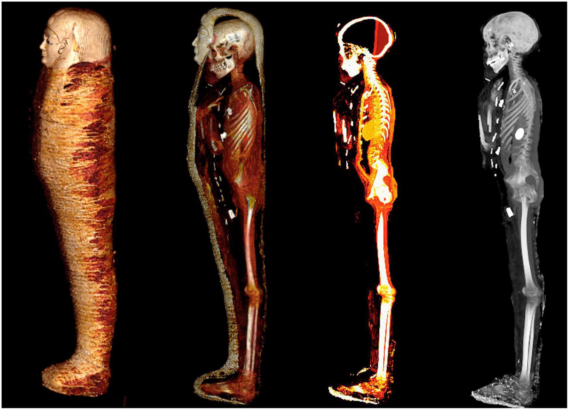 КТ-візуалізація мумії.&amp;nbsp;Sahar N. Saleem et al. / Frontiers in Medicine, 2023