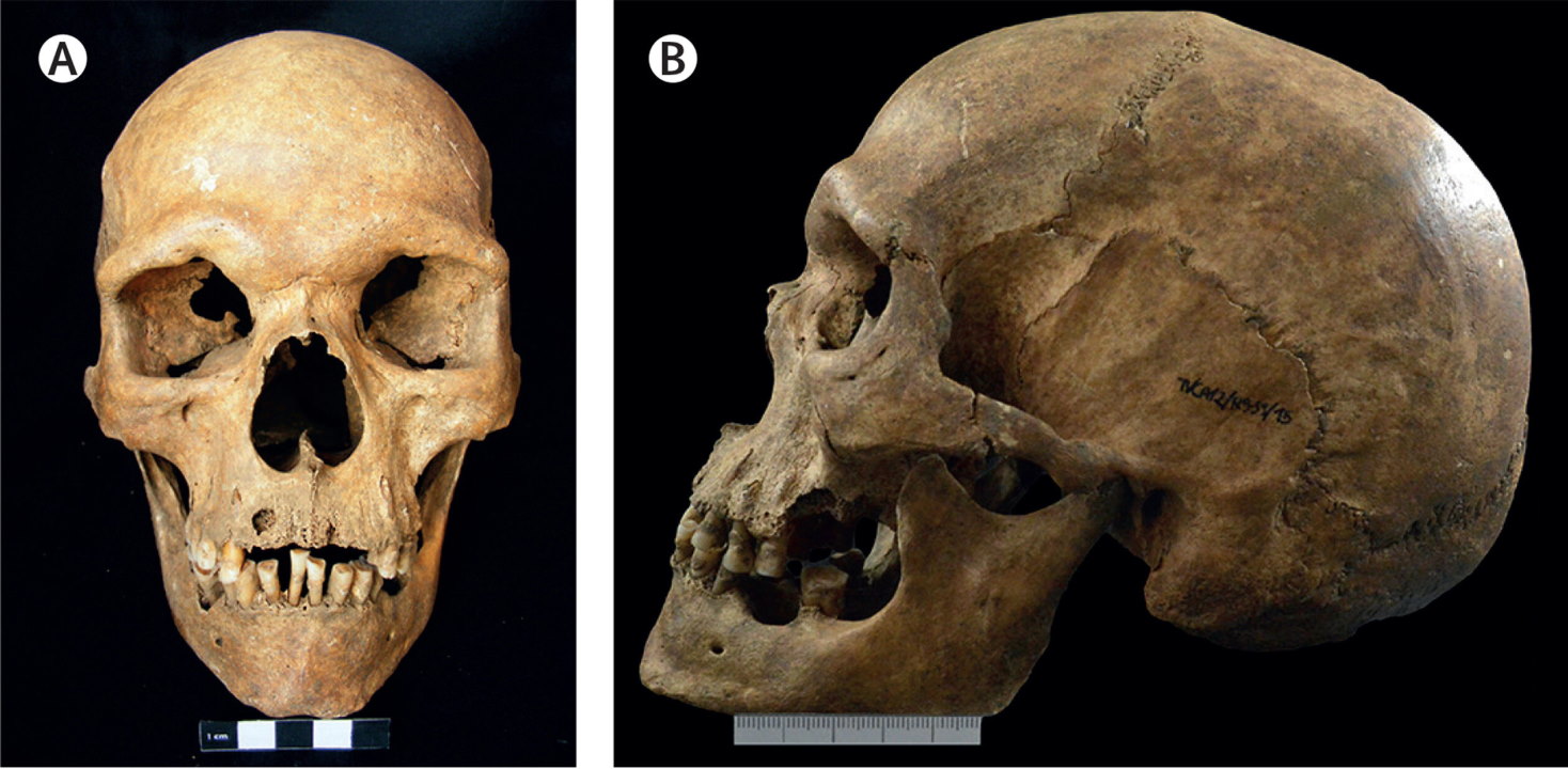 Тисячолітній череп людини із синдромом Клайнфельтера.&amp;nbsp;Xavier Roca-Rada et al. / The Lancet, 2022