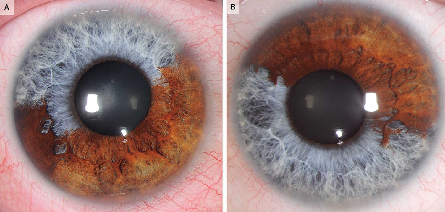 Очі швейцарського пацієнта із секторною гетерохромією.&amp;nbsp;Sadiq Said,&amp;nbsp;Frank Blaser / The New England Journal of Medicine, 2023