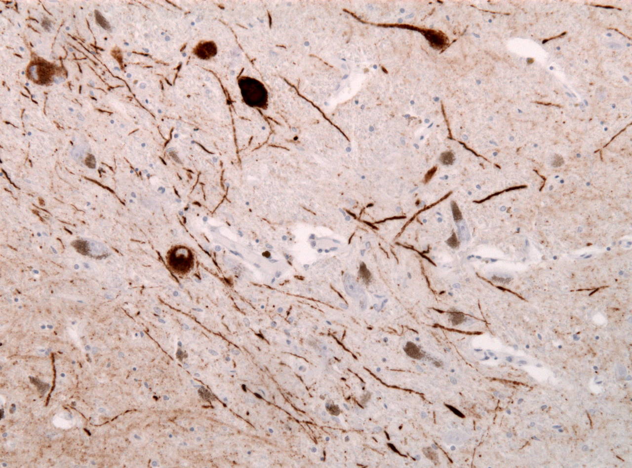 Скупчення альфа-синуклеїну в нейронах мозку пацієнта з деменцією з тільцями Леві.&amp;nbsp;Jensflorian /&amp;nbsp;Wikimedia Commons
