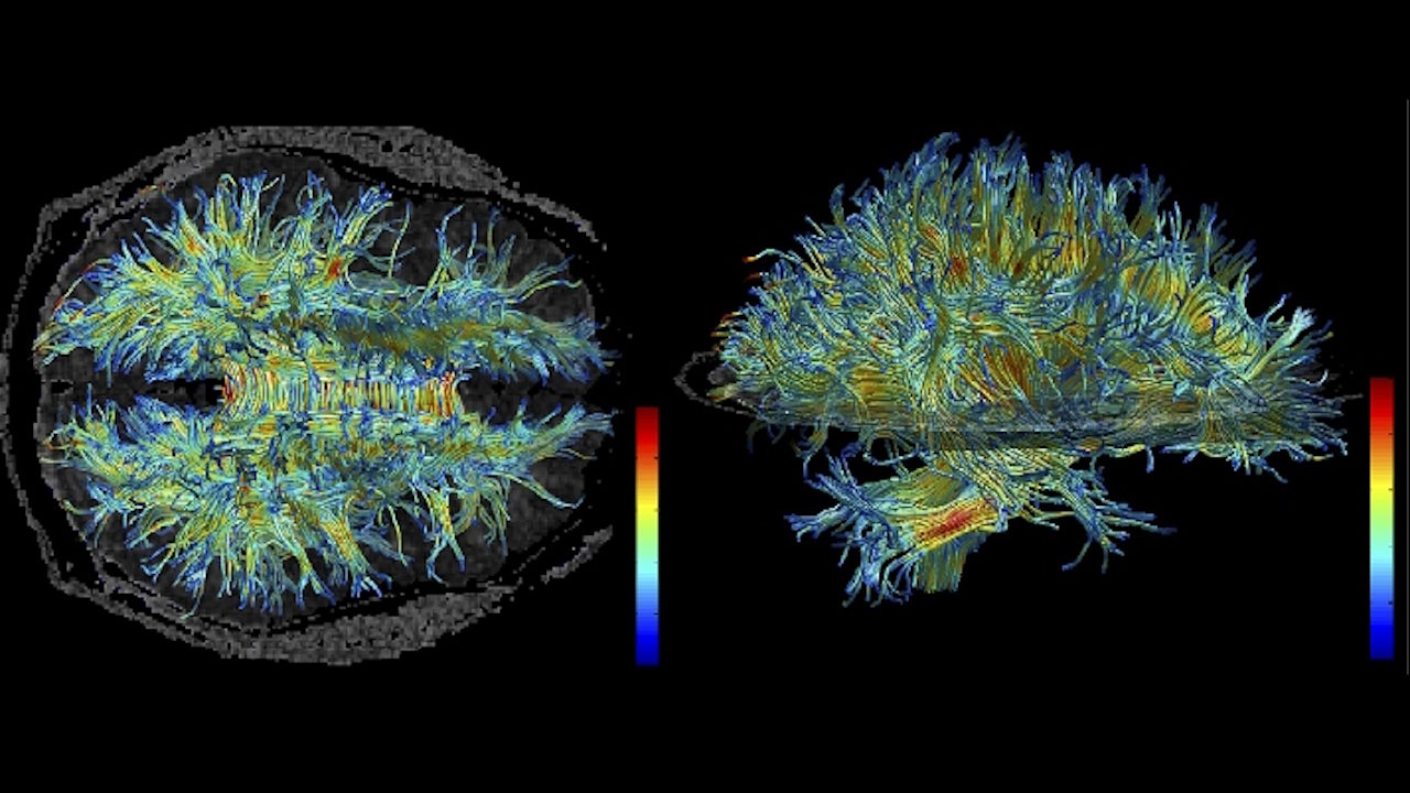 Структура білої речовини мозку людини, отримана за допомогою МРТ.&amp;nbsp;Wenples /&amp;nbsp;Wikimedia Commons