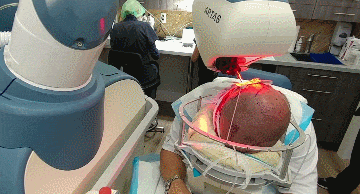 Робот Artas проводить трансплантацію волосся / Control Farayand Pasargad