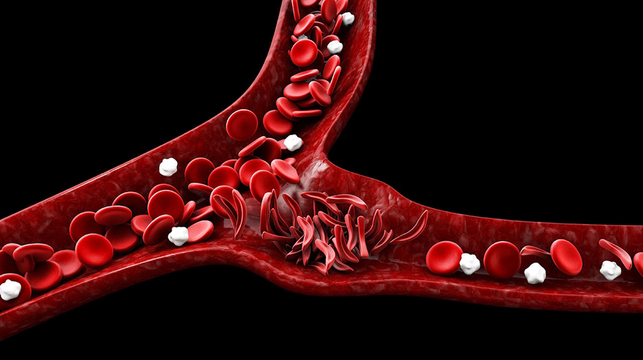 Художня ілюстрація закупорювання судини при серповидноклітинній анемії.&amp;nbsp;OSF HealthCare