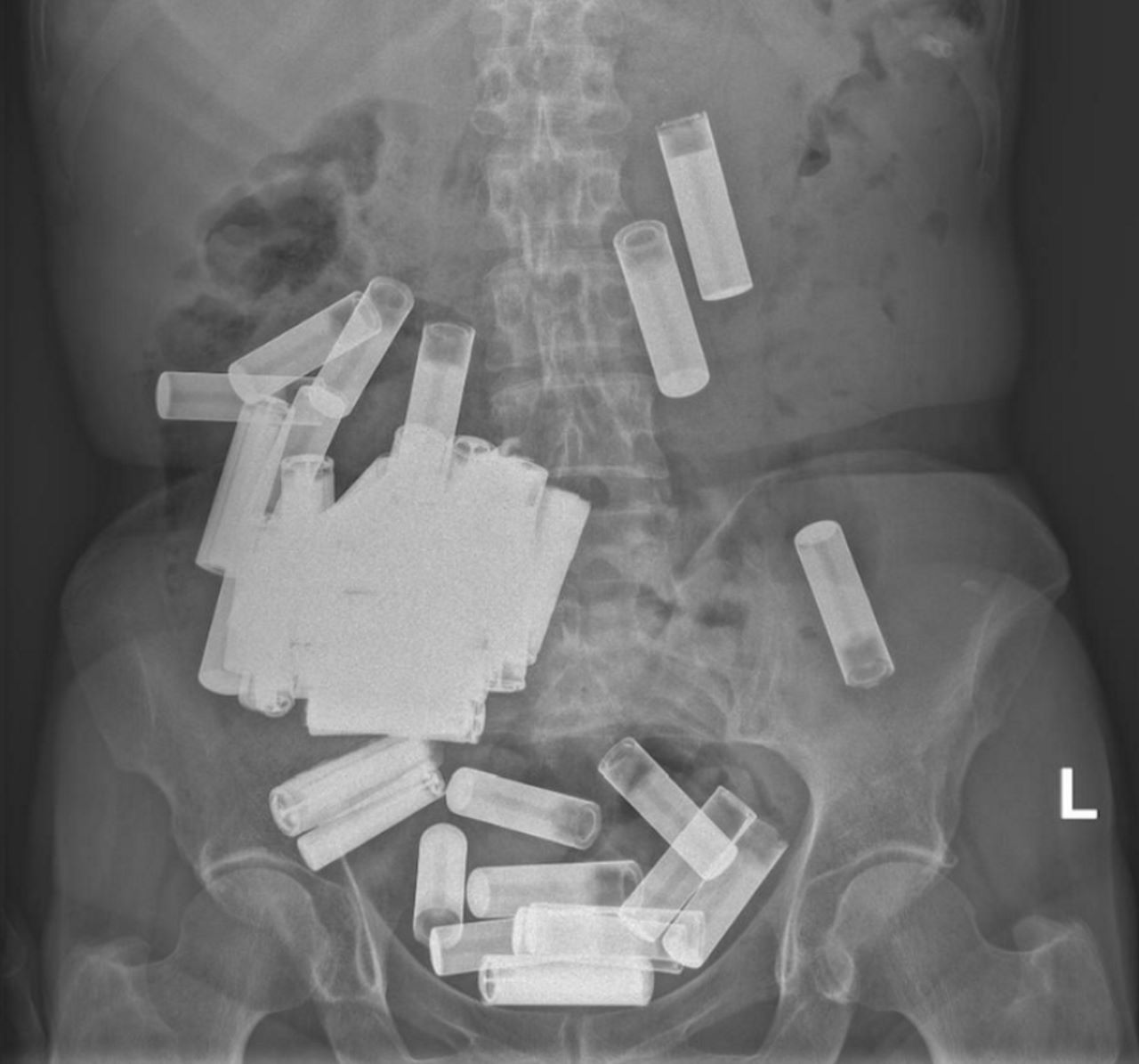 Рентген пацієнтки, на якому помітно значну кількість батарейок у черевній порожнині. C.J. O'Mahony et al . /&amp;nbsp;Irish Medical Journal, 2022