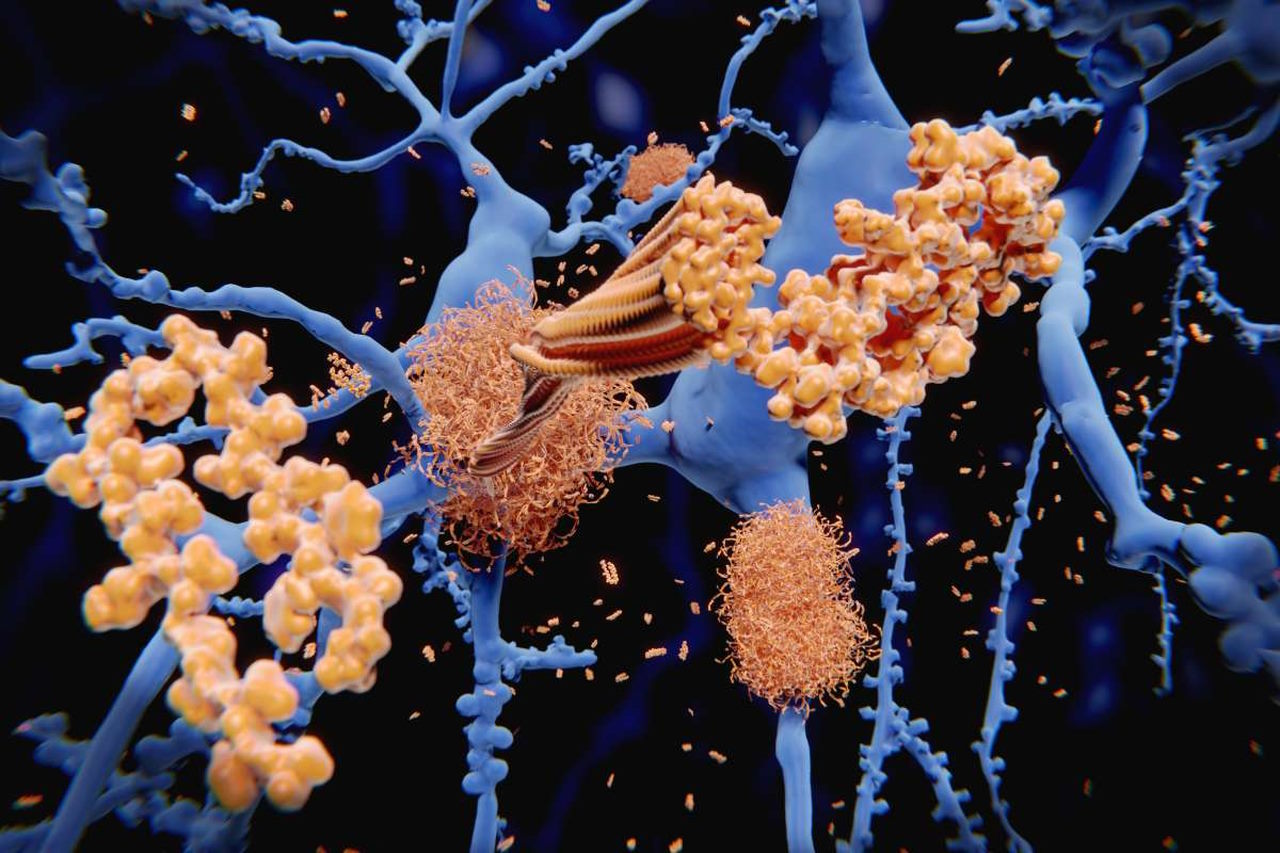 Ілюстрація скупчень бета-амілоїду між нейронами.&amp;nbsp;Juan Gärtner / Adobestock