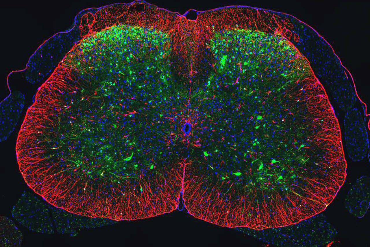 Поперечний зріз спинного мозку миші з СМА, де зеленим показано модифіковані вірусним вектором клітини.&amp;nbsp;Dan Wang, Ailing Du /&amp;nbsp;Broad Institute