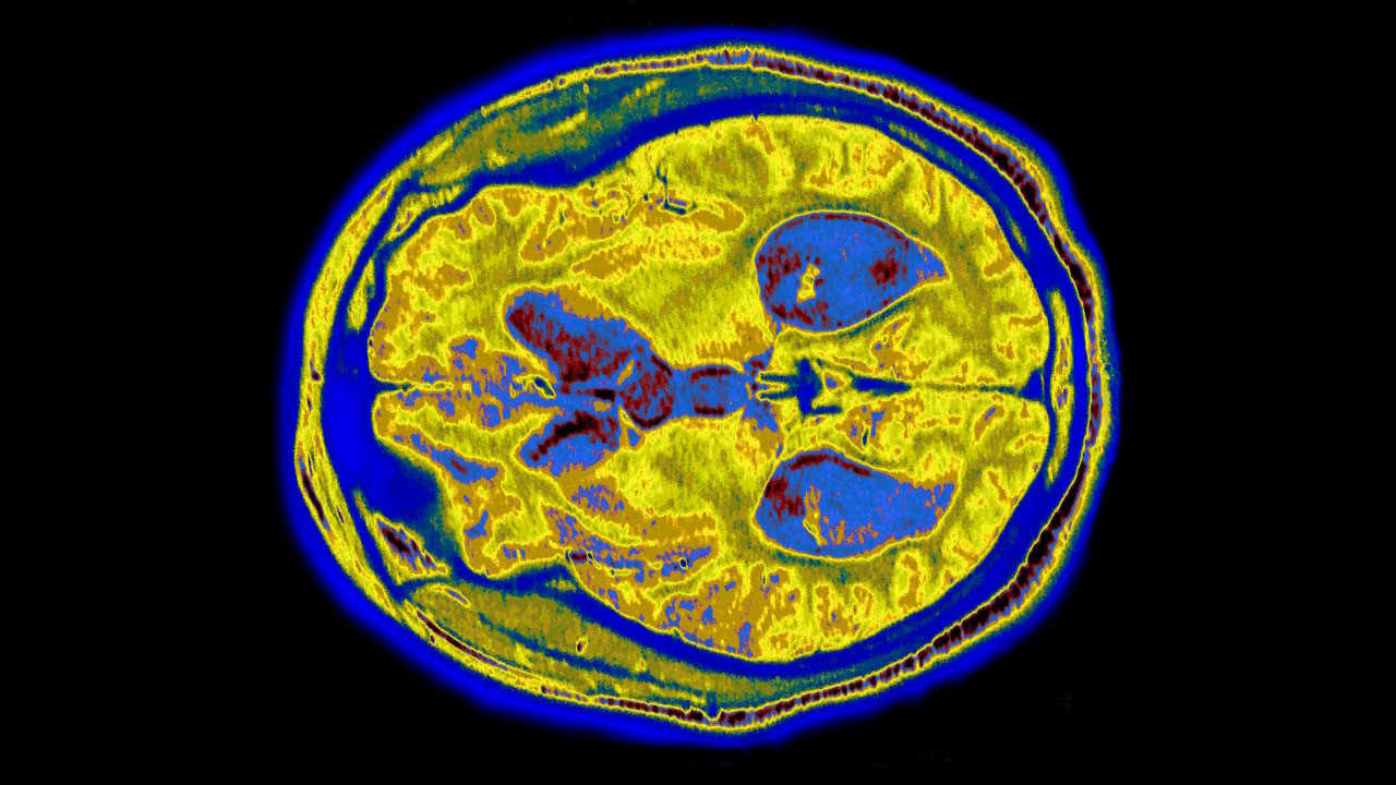 Томографія мозку людини з хворобою Альцгеймера. James Cavallini / Science Source