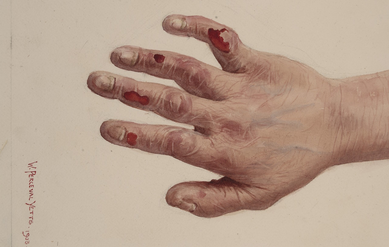 Малюнок руки з бульозним епідермолізом.&amp;nbsp;Wellcome Collection gallery