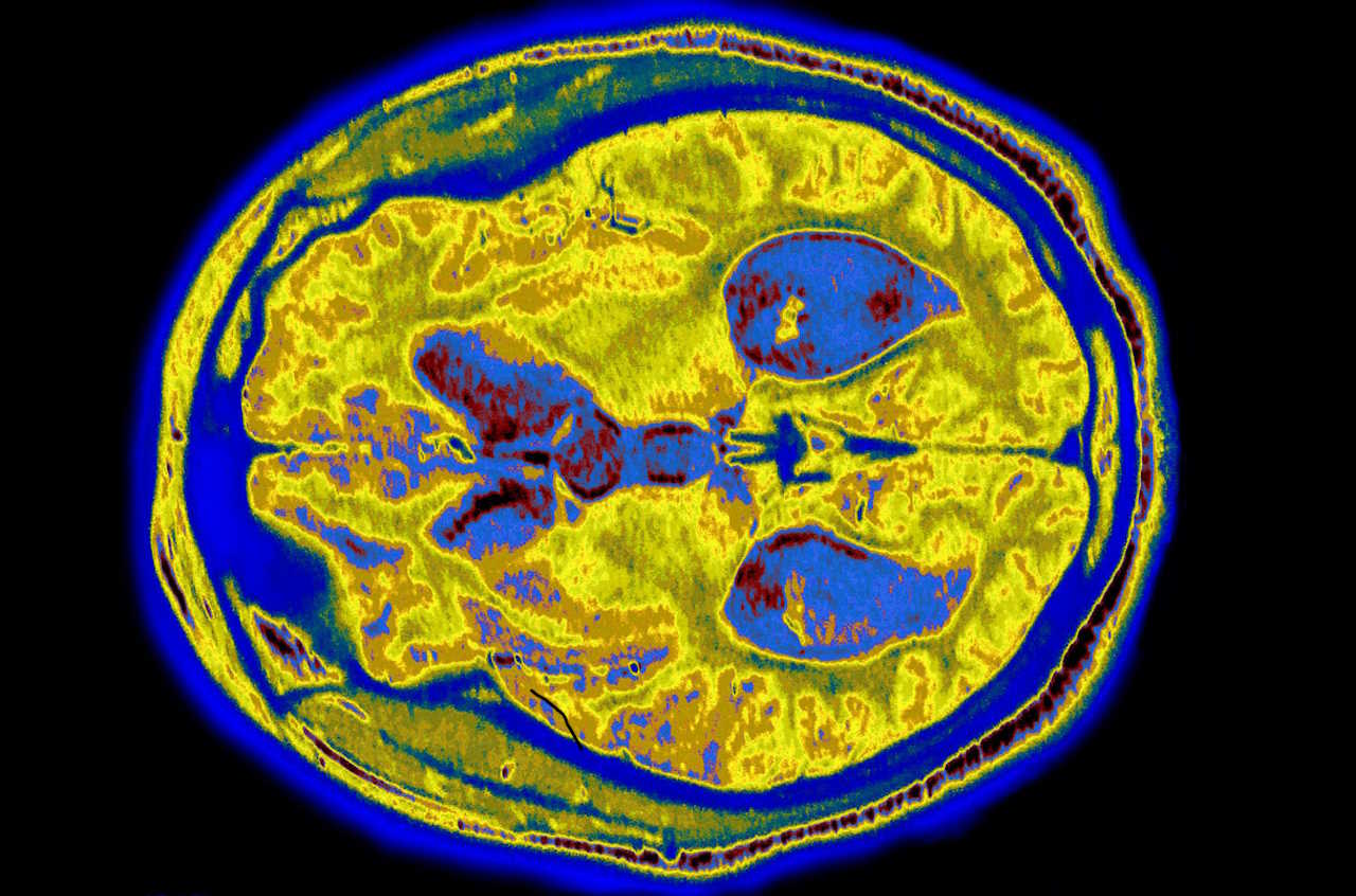 Скан мозку людини з проявами нейродегенерації.&amp;nbsp;James Cavallini / Science Source