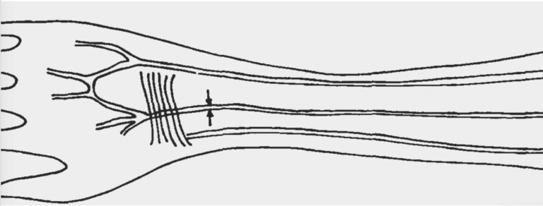 Схематичне зображення серединної артерії передпліччя. Maciej Henneberg