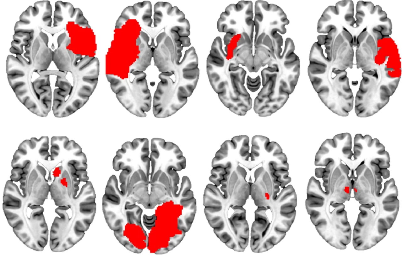 Зображення мозку пацієнтів із пошкодженими ділянками, виділеними червоним.&amp;nbsp;Juho Joutsa et al. /&amp;nbsp;Nature Medicine, 2022