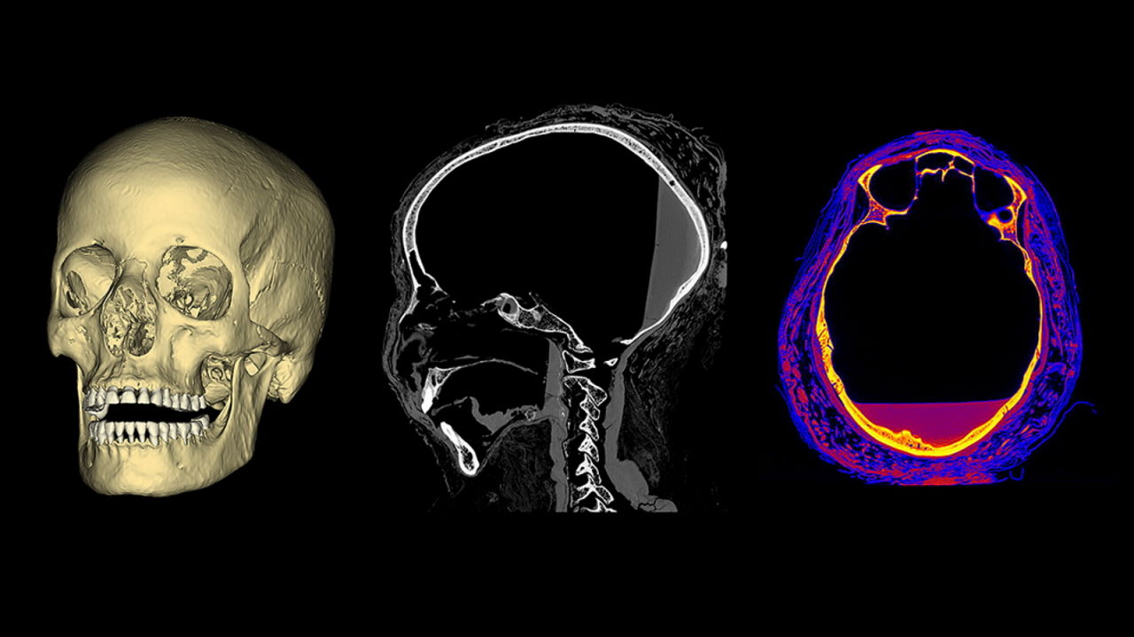 3D-реконструкція та зображення КТ черепа вагітної мумії. На третьому зображенні помітно невелику порожнину позаду орбіти ока, яка може бути слідом пухлини.&amp;nbsp;M.Ożarek-Szilke / Warsaw Mummy Project