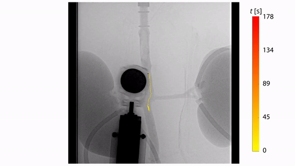 Рентгенівське зображення роборуки, що крутить магнітом над кровоносними судинами свині, де проходить мініробот (жовта лінія).&amp;nbsp;University of Twente