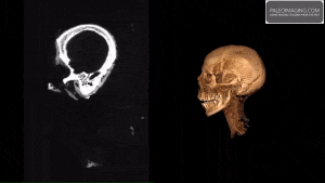 Зображення комп'ютерної томографії та тривимірна модель голови.&amp;nbsp;James Elliott / Twitter