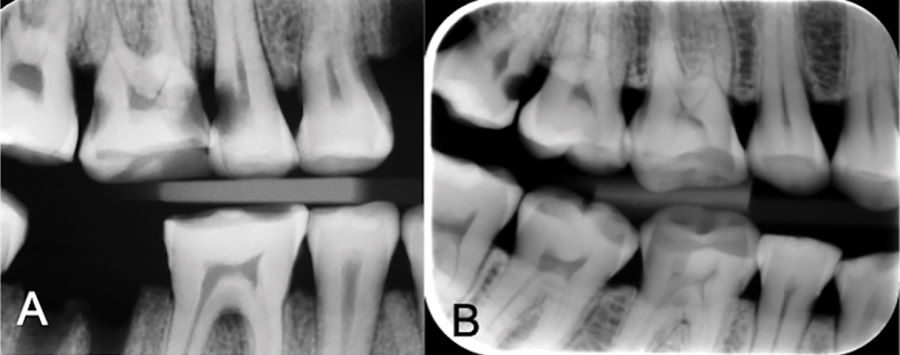 Зношування зубів (А), а також результати колупання між зубами (В). Carolina Bertilsson et al. / PLOS One, 2023