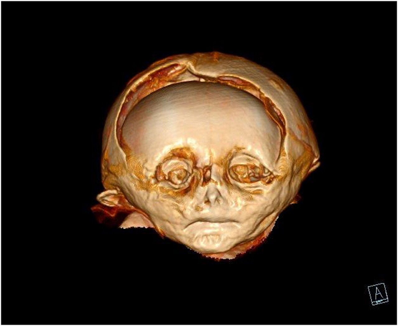 Скан голови мумії хлопчика.&amp;nbsp;Andreas Nerlich et al. /&amp;nbsp;Frontiers in Medicine, 2022