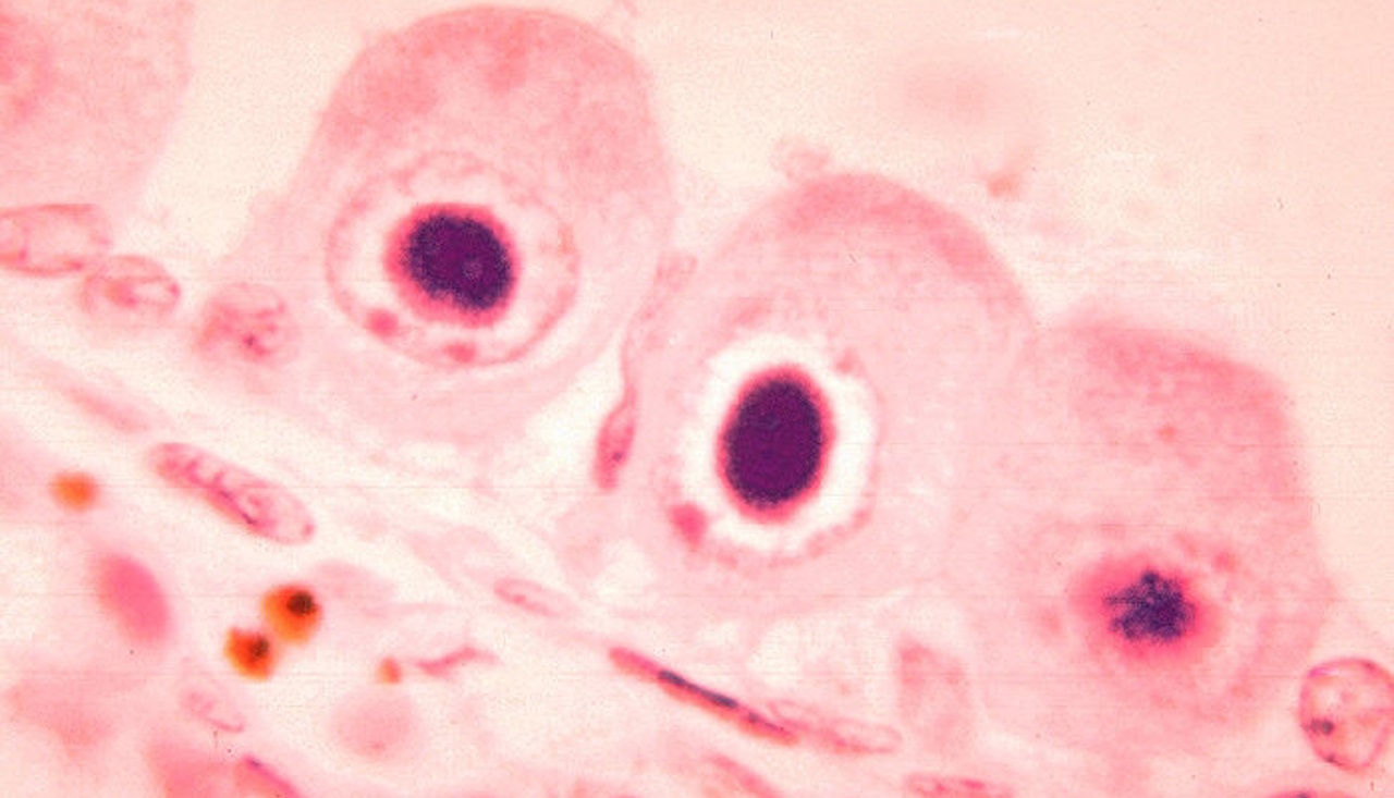 Цитомегаловіруси у клітинах нирки.&amp;nbsp;CDC / Dr. Haraszti /&amp;nbsp;Wikimedia Commons