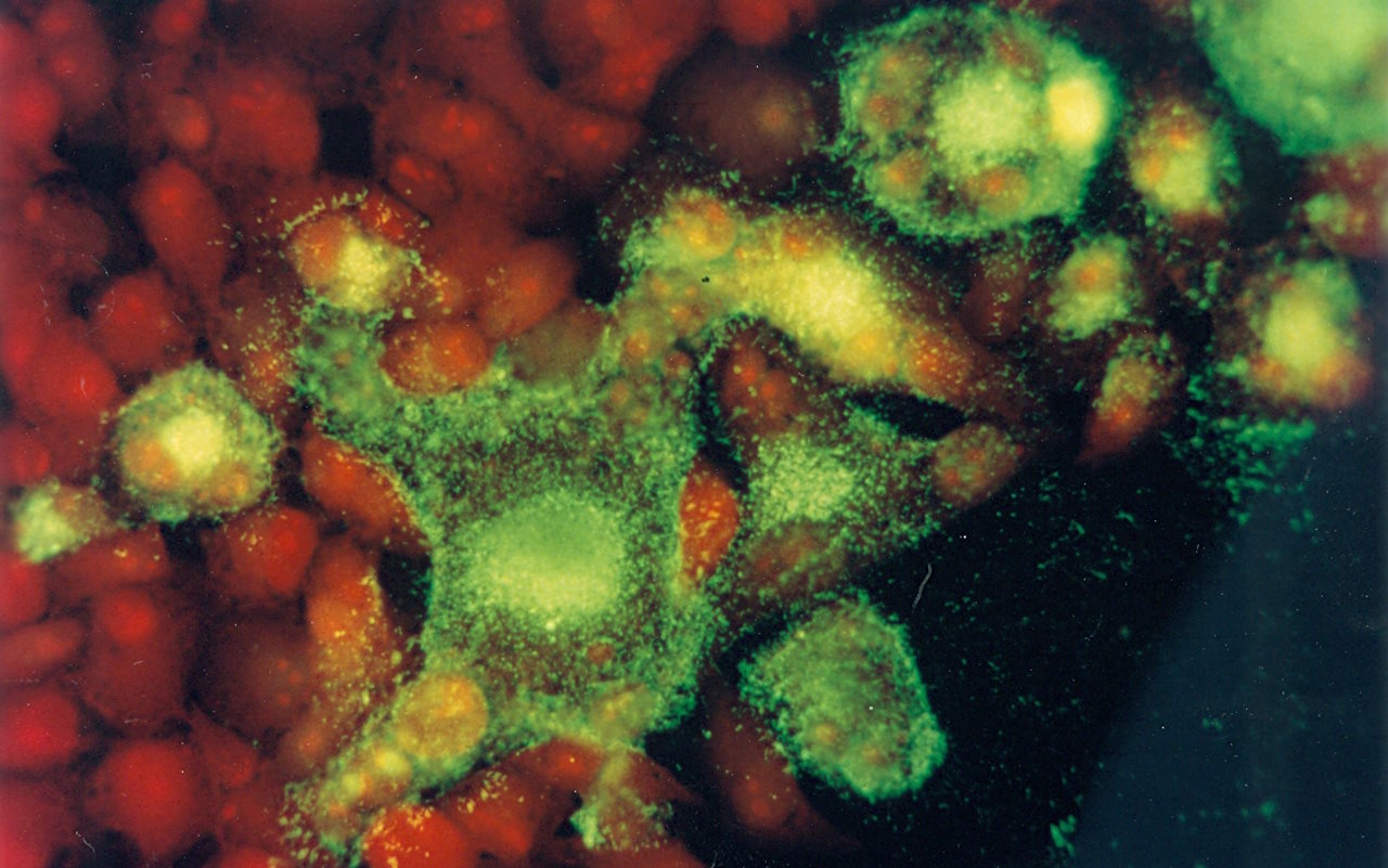 Клітини (червоні), інфіковані вірусом респіраторно-синцитіального вірусу (зелені).&amp;nbsp;UT Southwestern