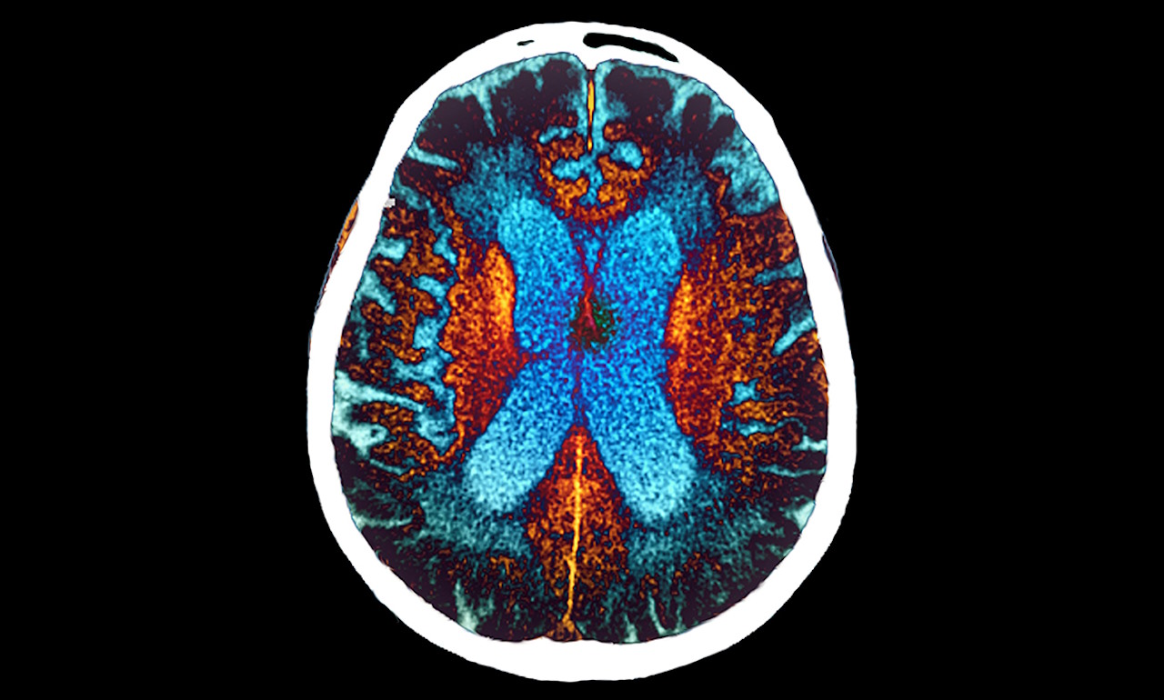 Скан мозку людини з хворобою Альцгеймера.&amp;nbsp;ZEPHYR / Science Source