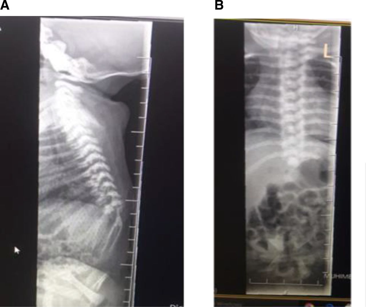Рентгенологічне обстеження хлопчика з синдромом каудальної регресії.&amp;nbsp;Karim Premji Manji et al. / BMJ Case Reports, 2023
