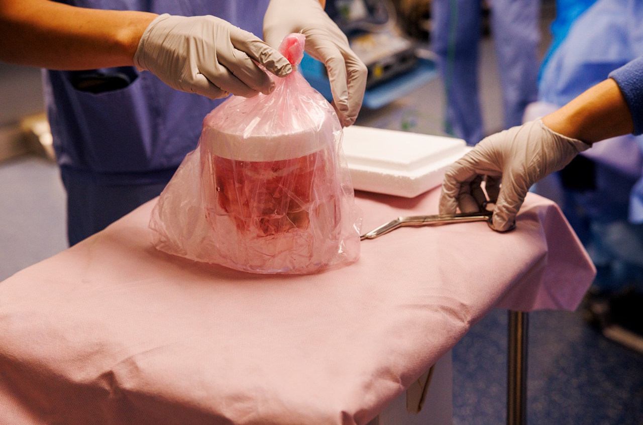 Нирка генетично модифікованої свині перед пересадкою Тіму Ендрюзу. Kate Flock / Massachusetts General Hospital