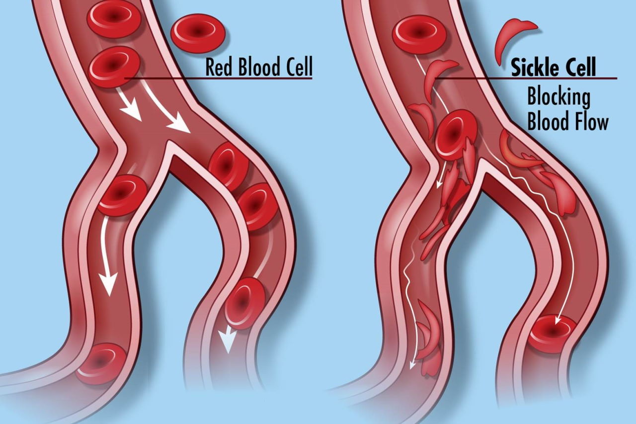Нормальні клітини крові (ліворуч) і клітини крові при серповидноклітинній анемії. National Human Genome Research Institute / Flickr